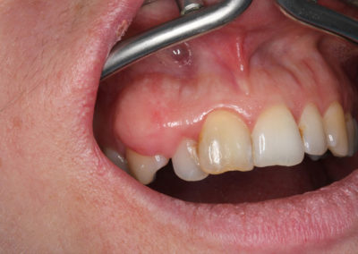 Zduření dásně u pravého horního špičáku
