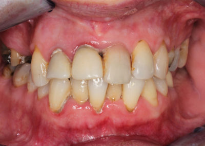 Dutina ústní postižená paradontopatií.